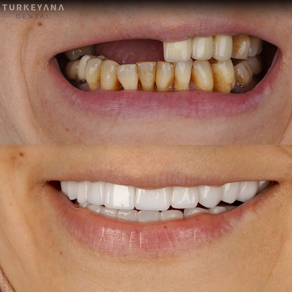 Implants Dentaires — Turkeyana