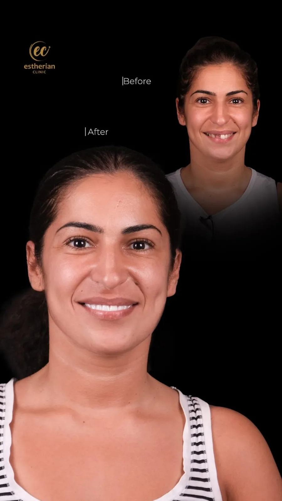 Couronnes Dentaires — Estherian clinic