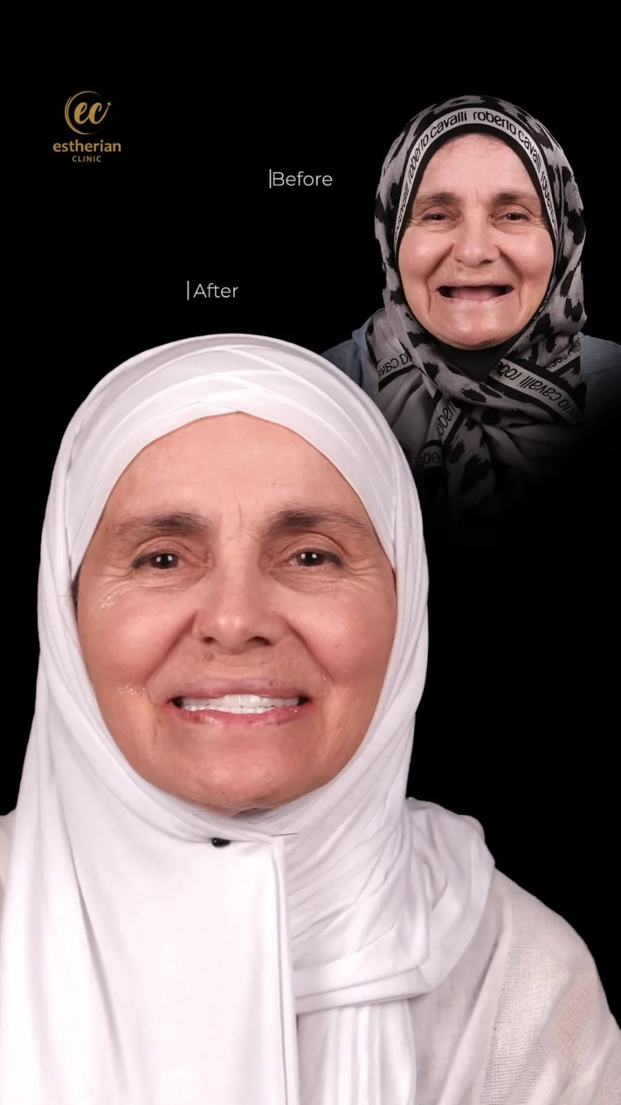 Couronnes Dentaires — Estherian clinic