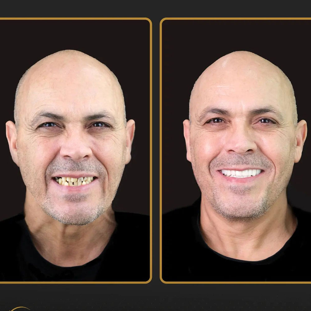 Couronnes Dentaires — Estherian clinic