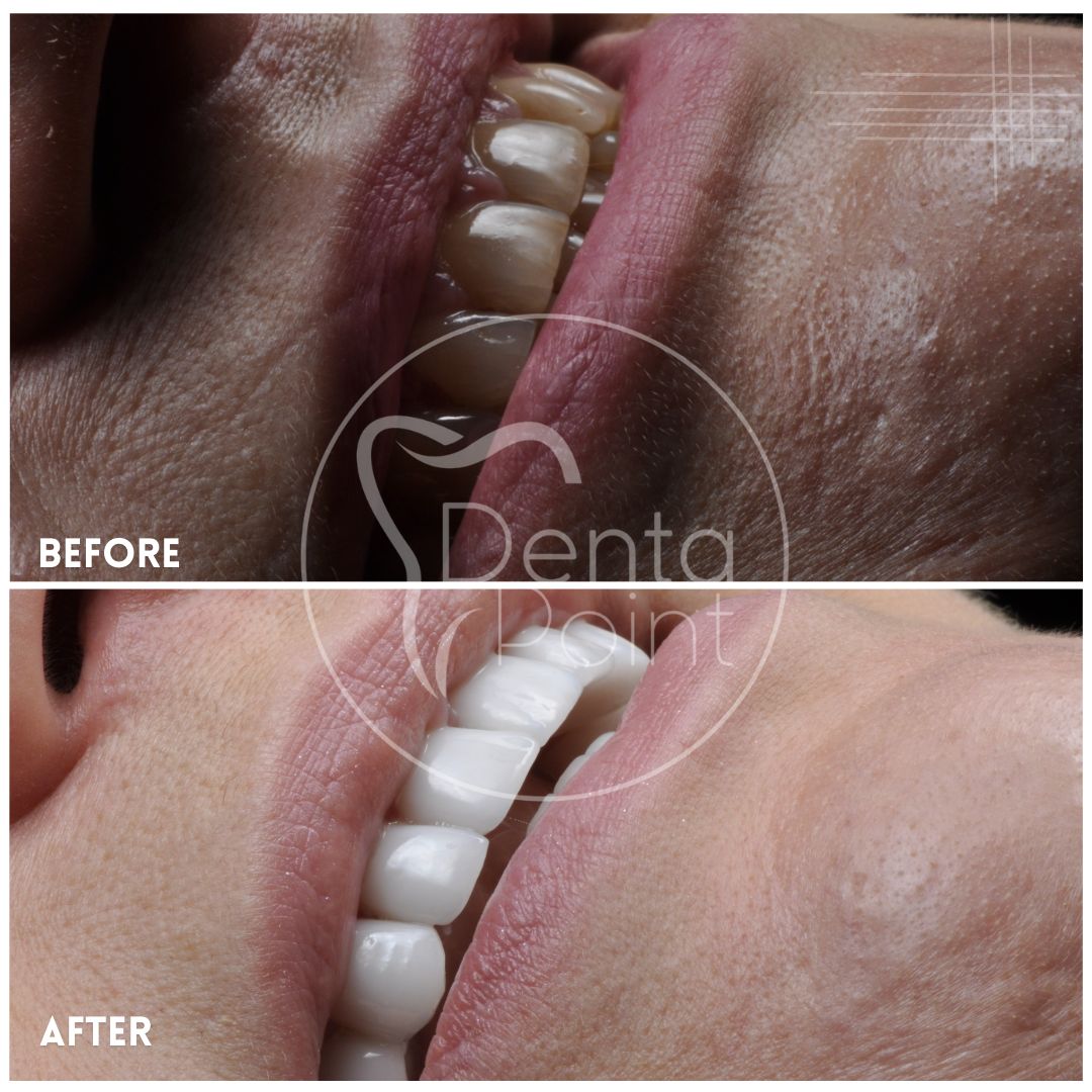 Facettes Emax — Dentapoint