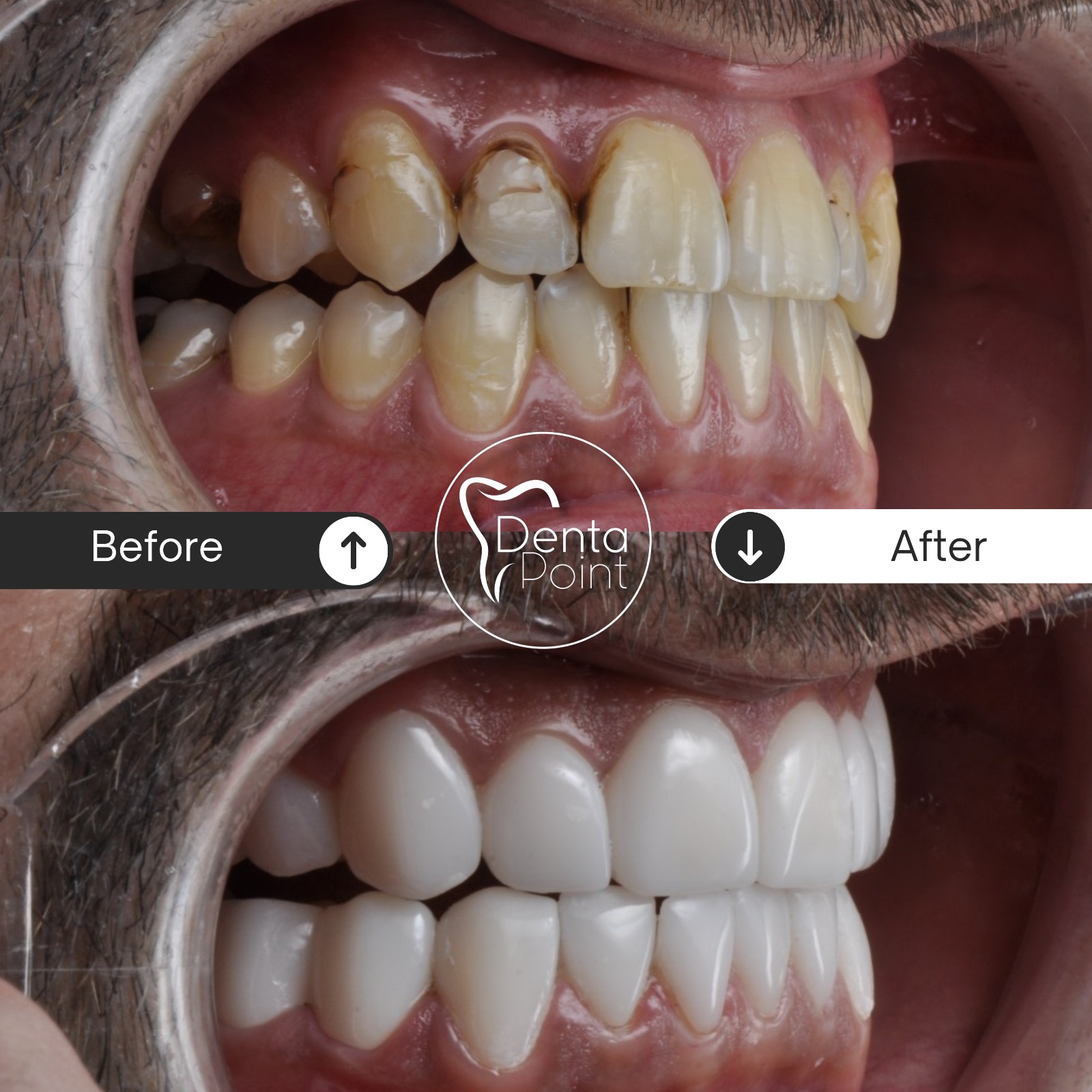 Facettes Emax — Dentapoint