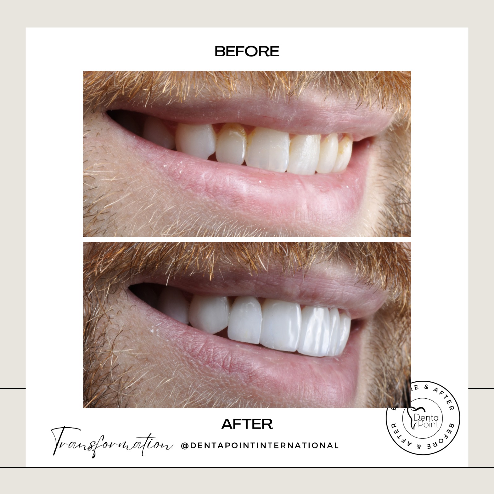 Facettes Emax — Dentapoint