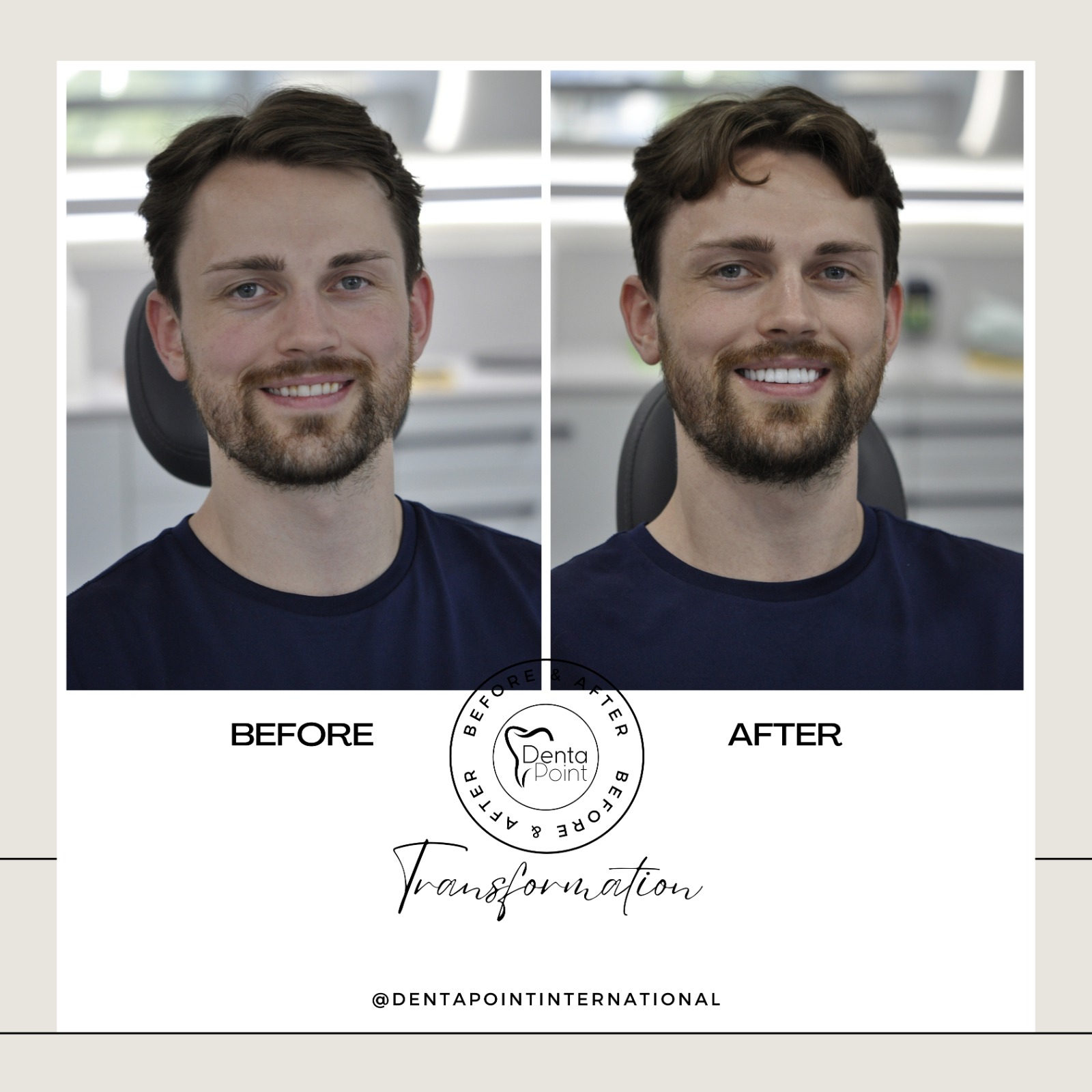 Facettes Emax — Dentapoint