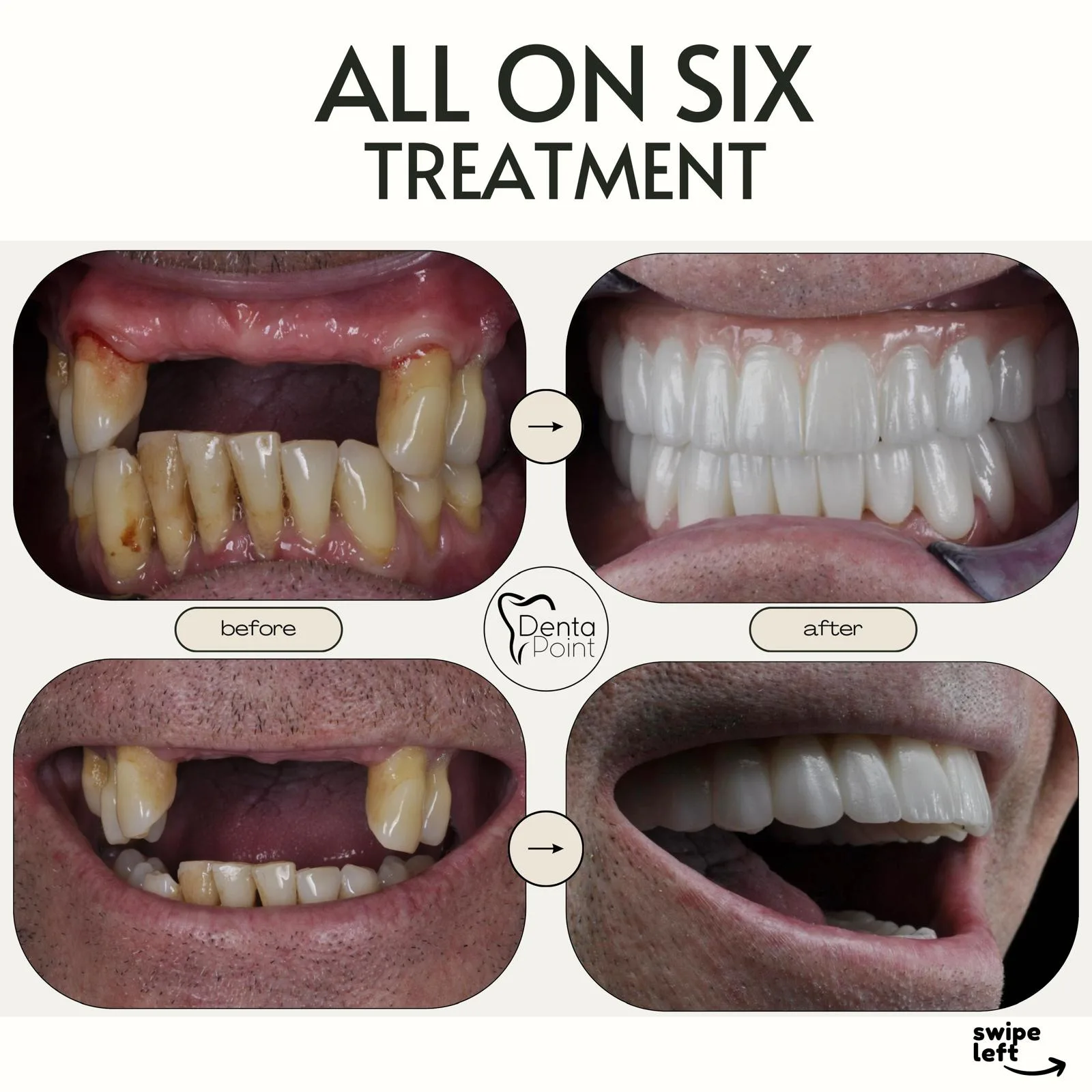All-On-6 — Dentapoint