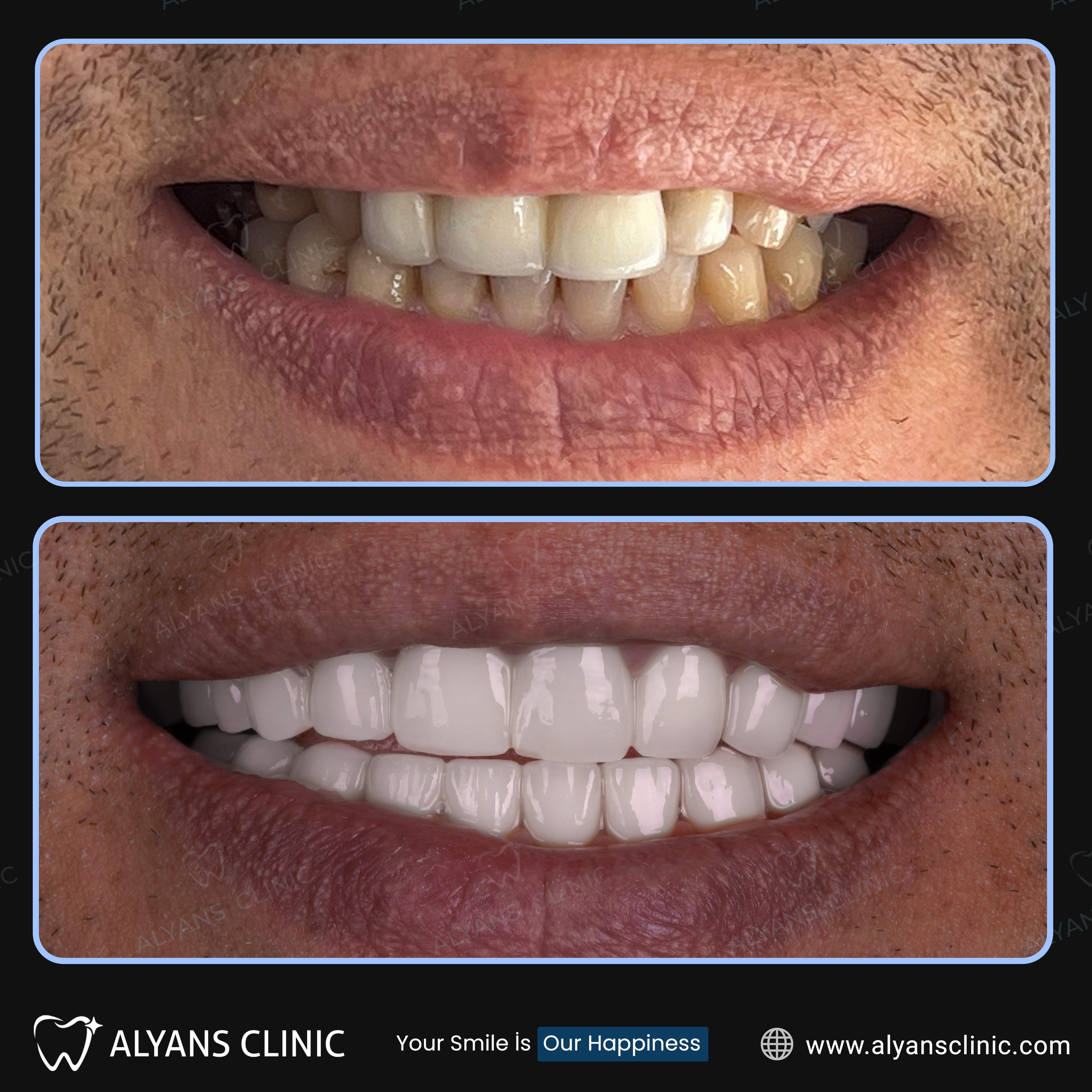 Reconstruction Totale — Alyans Clinic
