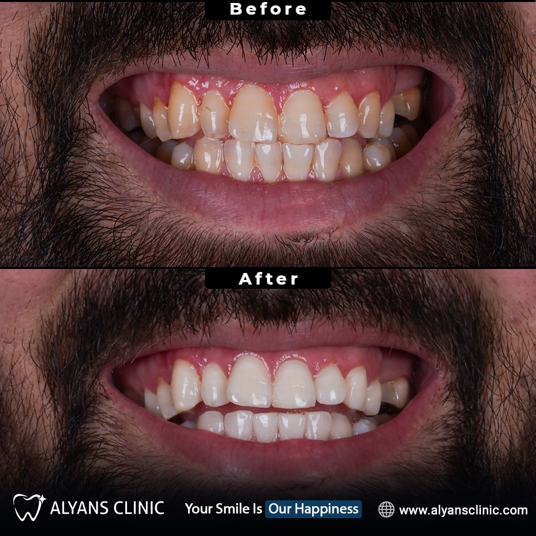 Couronnes Dentaires — Alyans Clinic