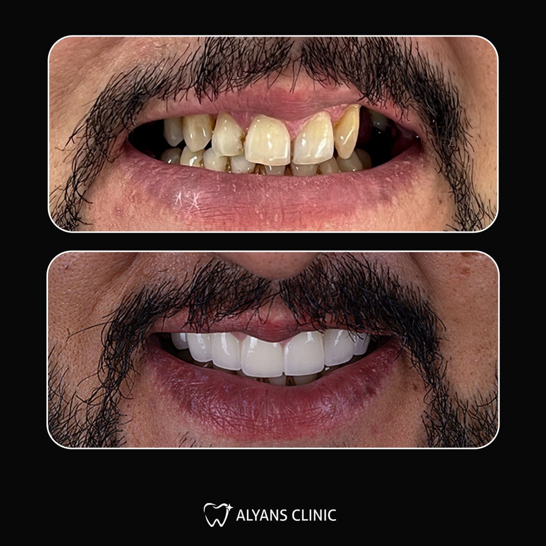 Couronnes Dentaires — Alyans Clinic