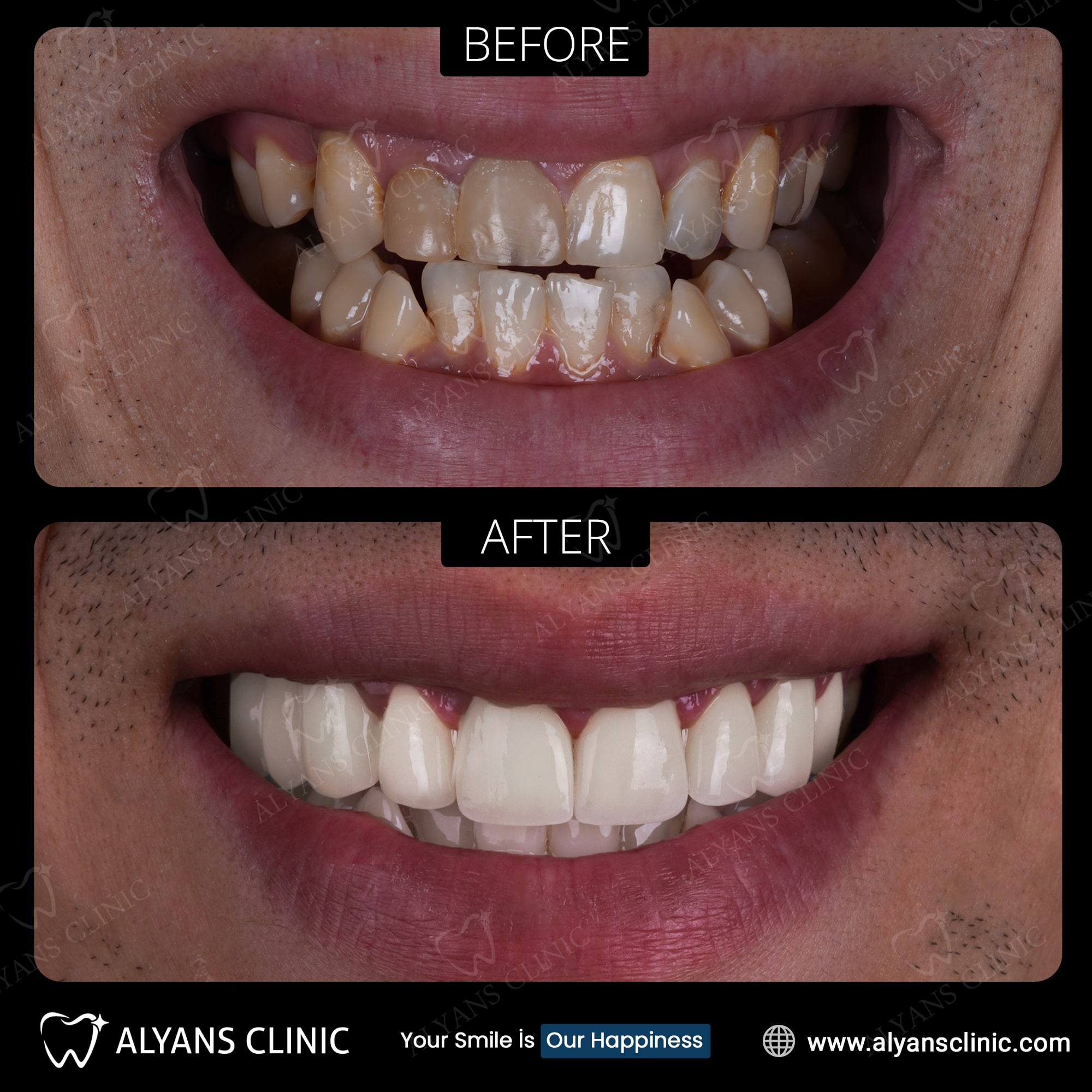 Couronnes Dentaires — Alyans Clinic
