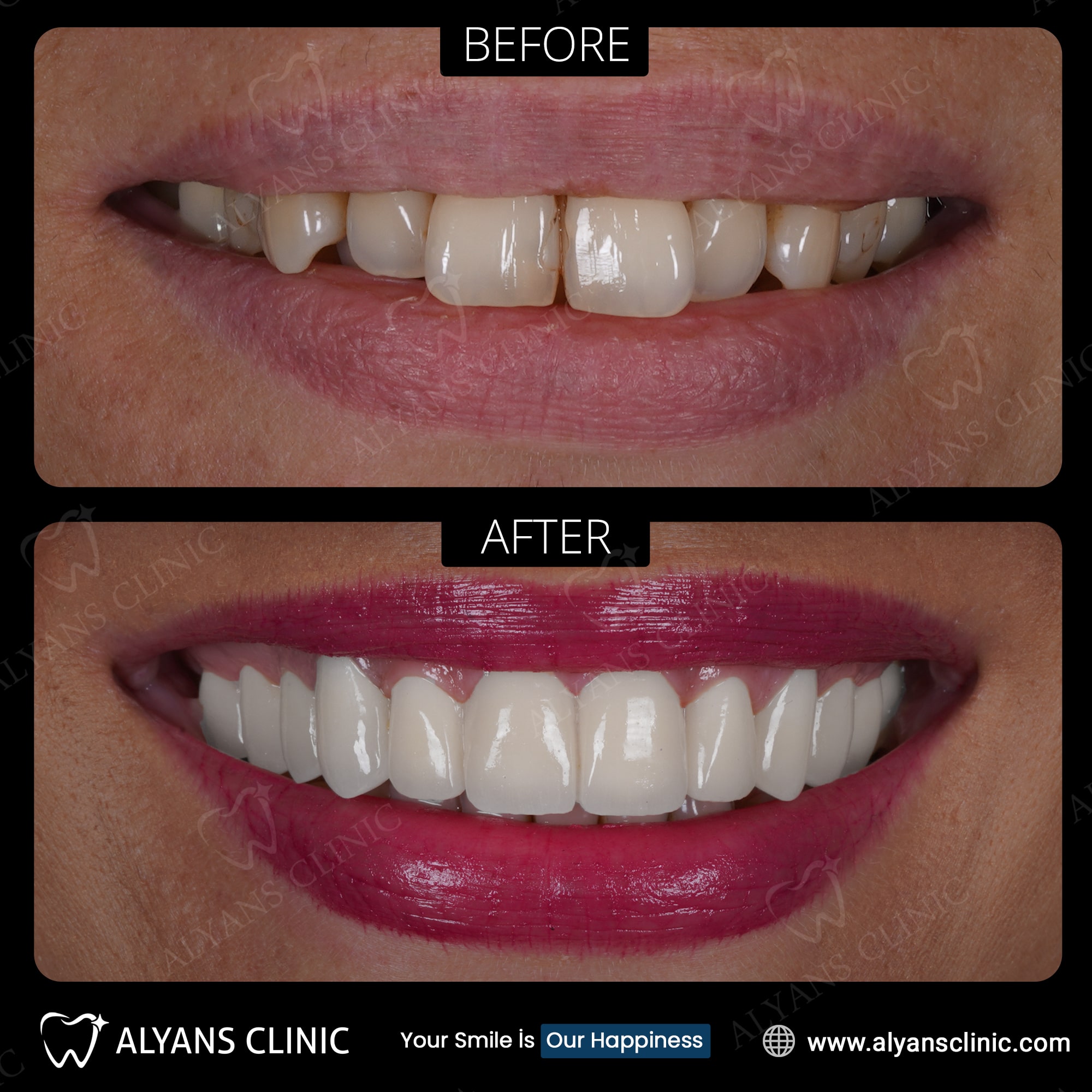 Couronnes Dentaires — Alyans Clinic