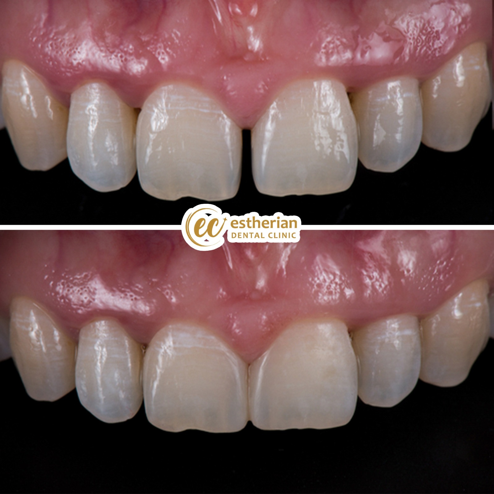 Facettes Dentaires — Estherian clinic