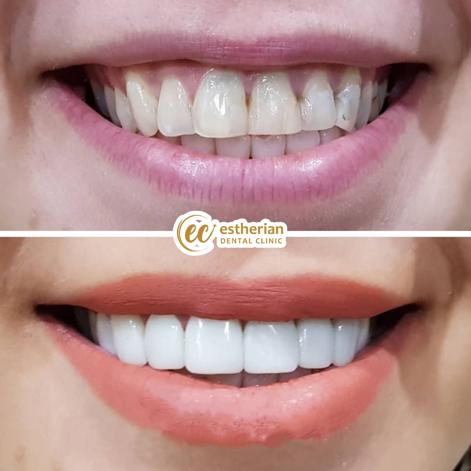 Facettes Pelliculaires — Estherian clinic