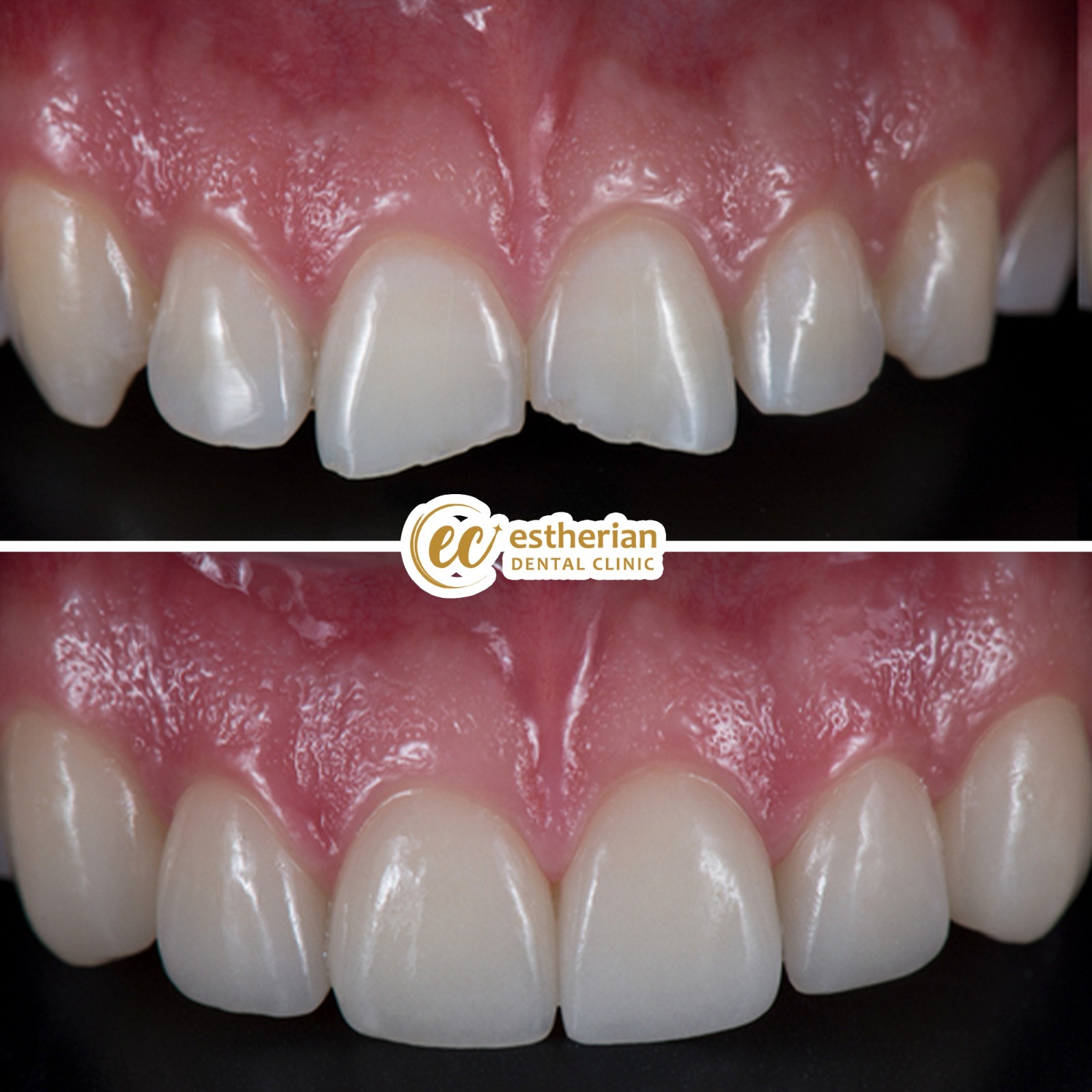 Facettes Pelliculaires — Estherian clinic