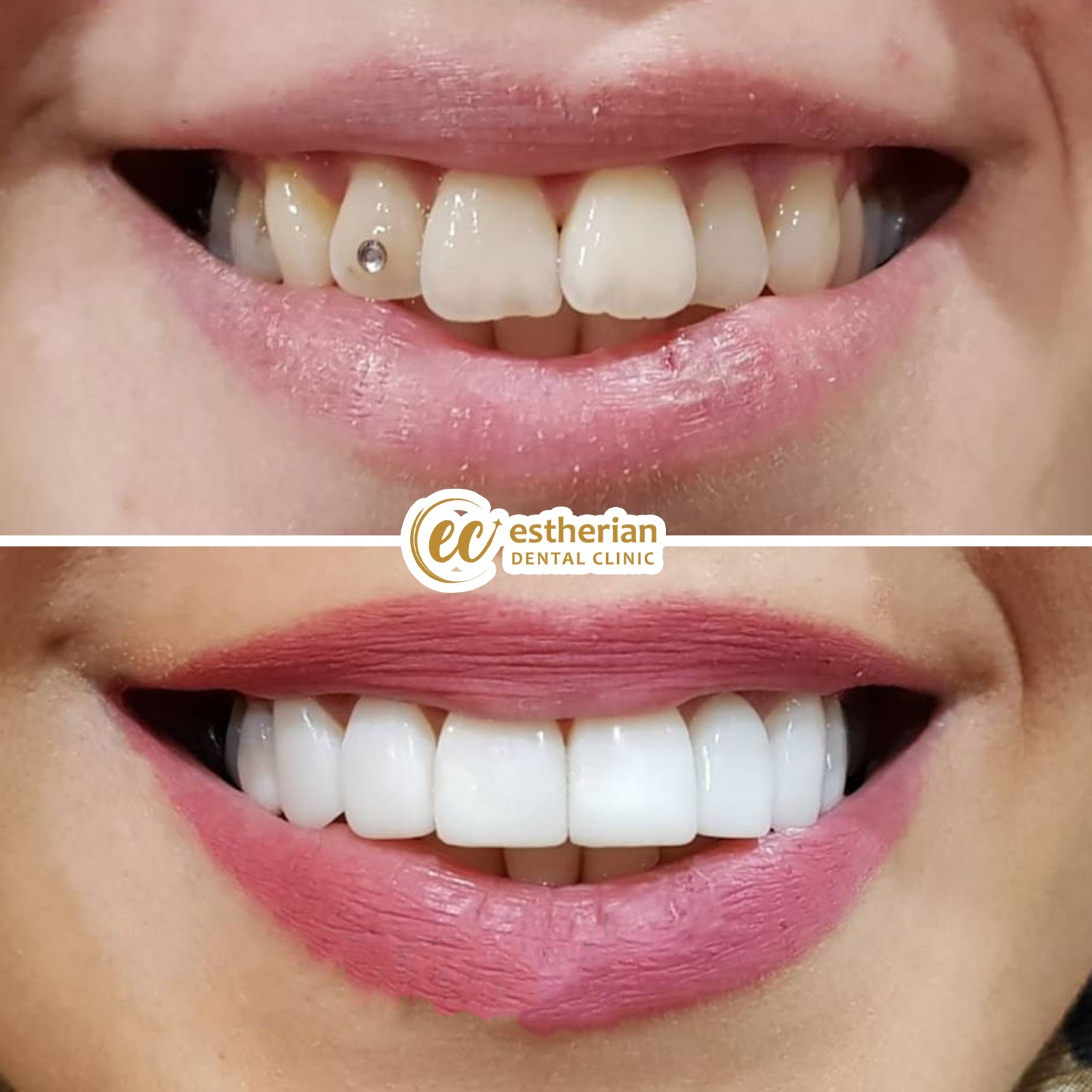 Facettes Pelliculaires — Estherian clinic