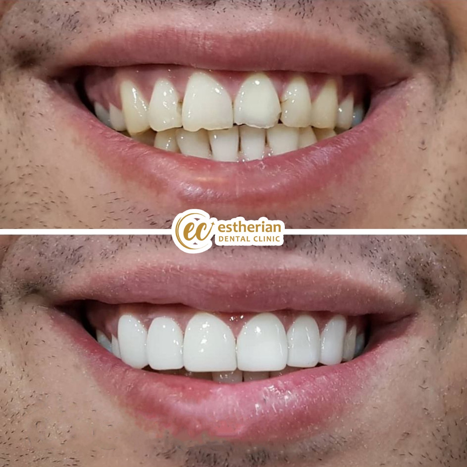 Facettes Pelliculaires — Estherian clinic