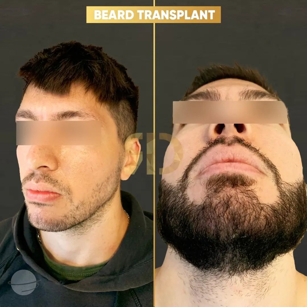 Beard Transplant by Esthetic Planet Team
