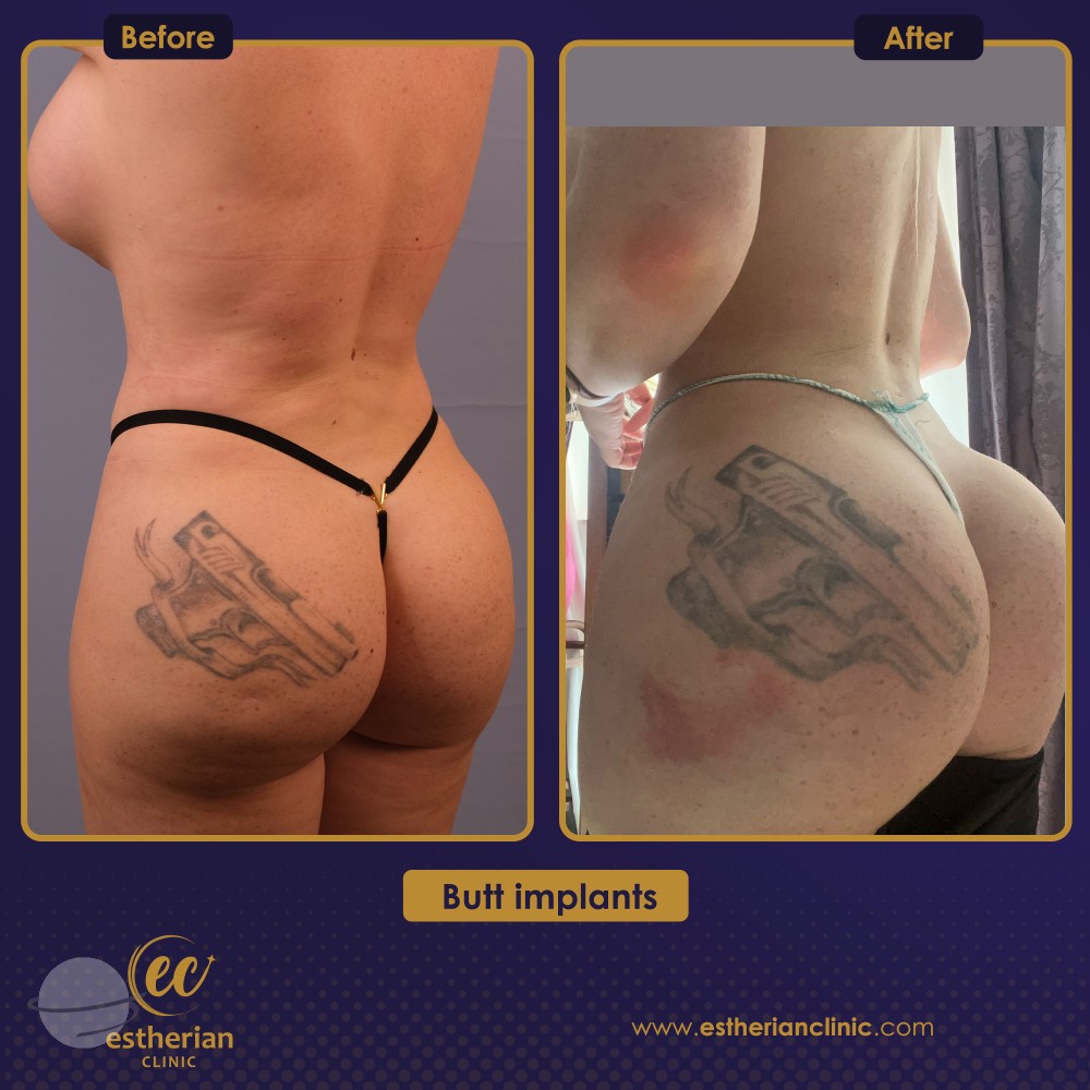 Brazilian Butt Lift (Condensed Rich Fat Injection To Enhance