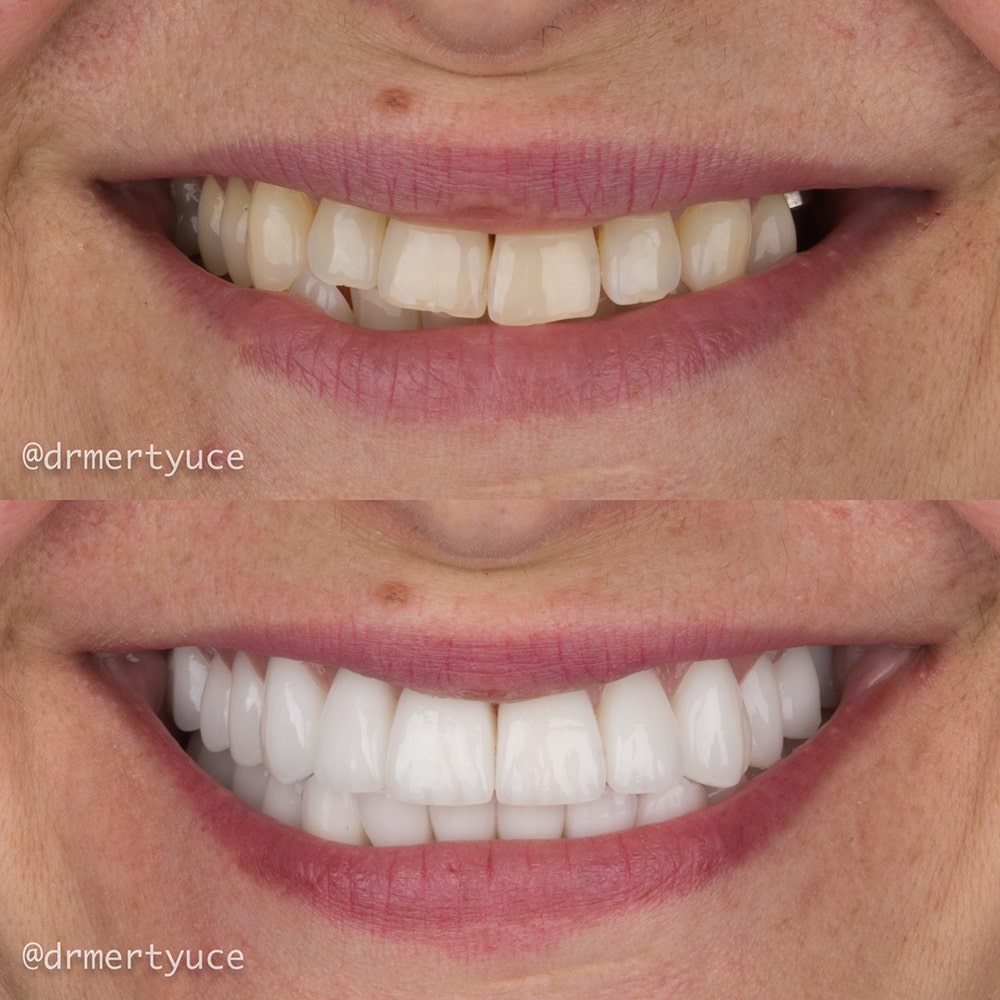 Facettes Dentaires — Dentaglobal