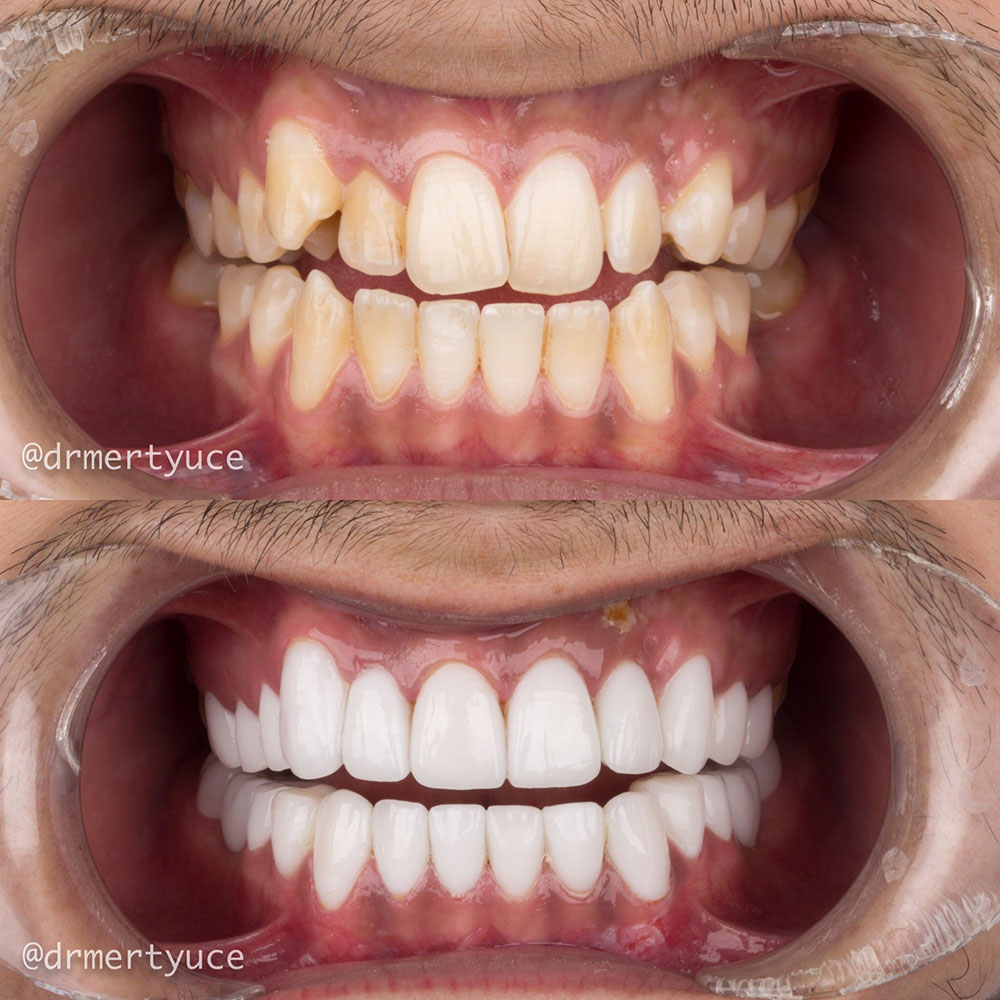 Facettes Dentaires — Dentaglobal
