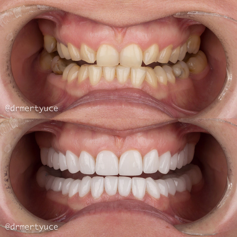 Facettes Dentaires — Dentaglobal