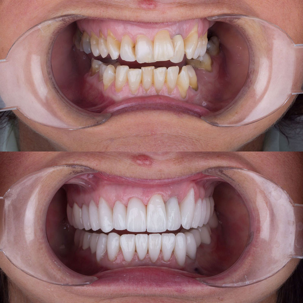 Facettes Dentaires — Dentaglobal