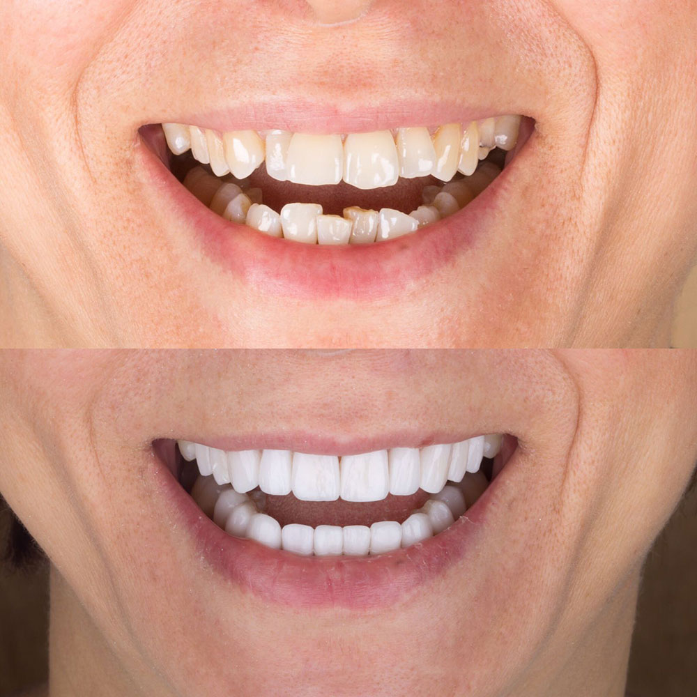 Facettes Dentaires — Dentaglobal
