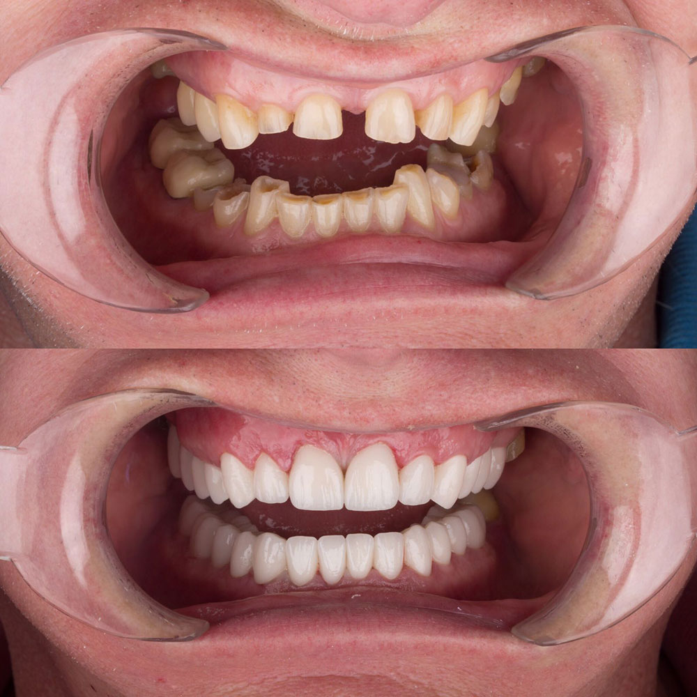 Facettes Dentaires — Dentaglobal