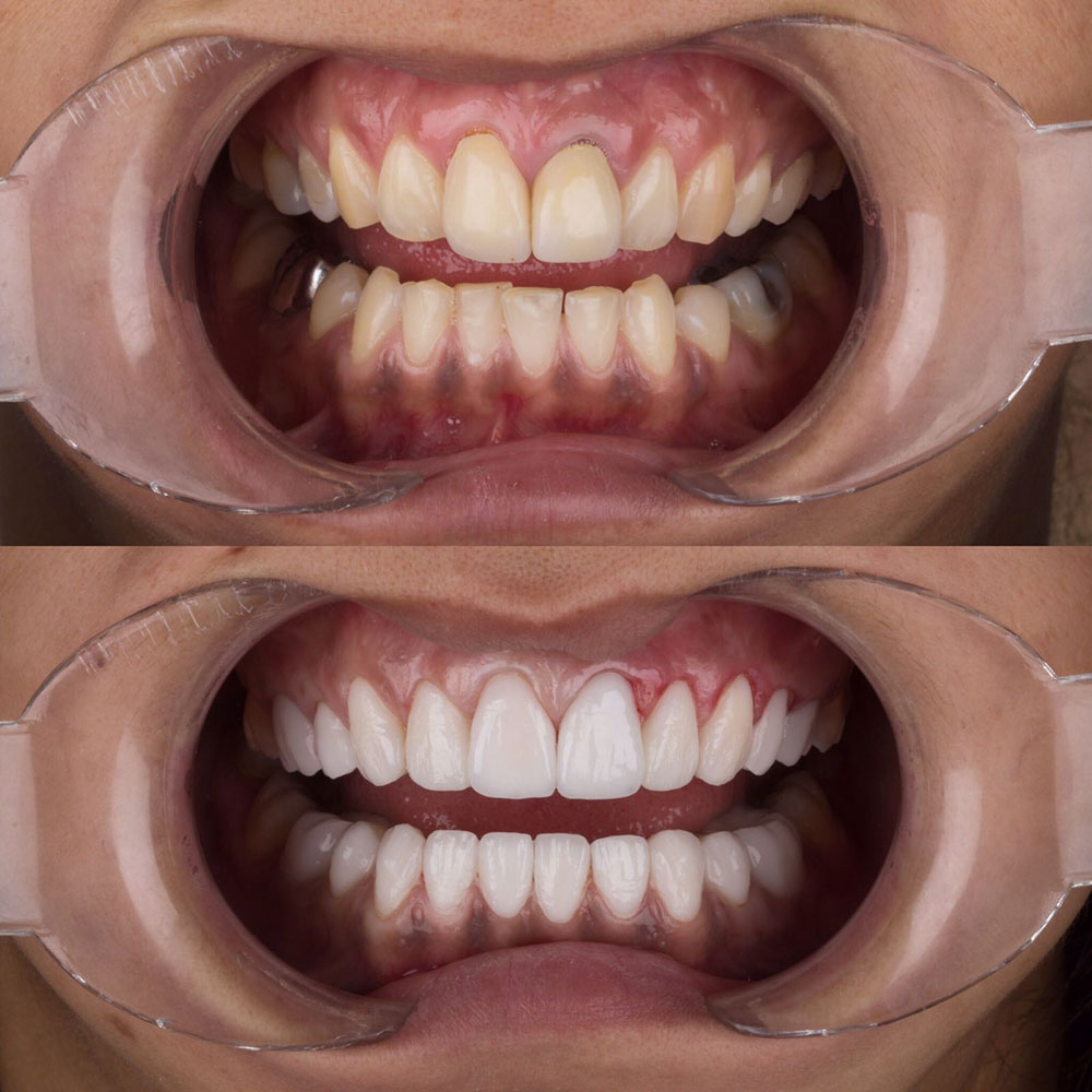 Facettes Dentaires — Dentaglobal