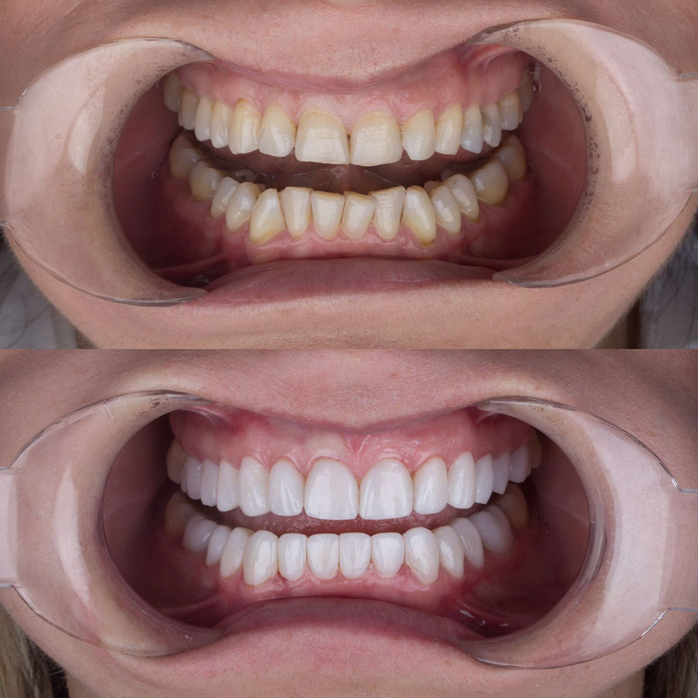 Facettes Dentaires — Dentaglobal