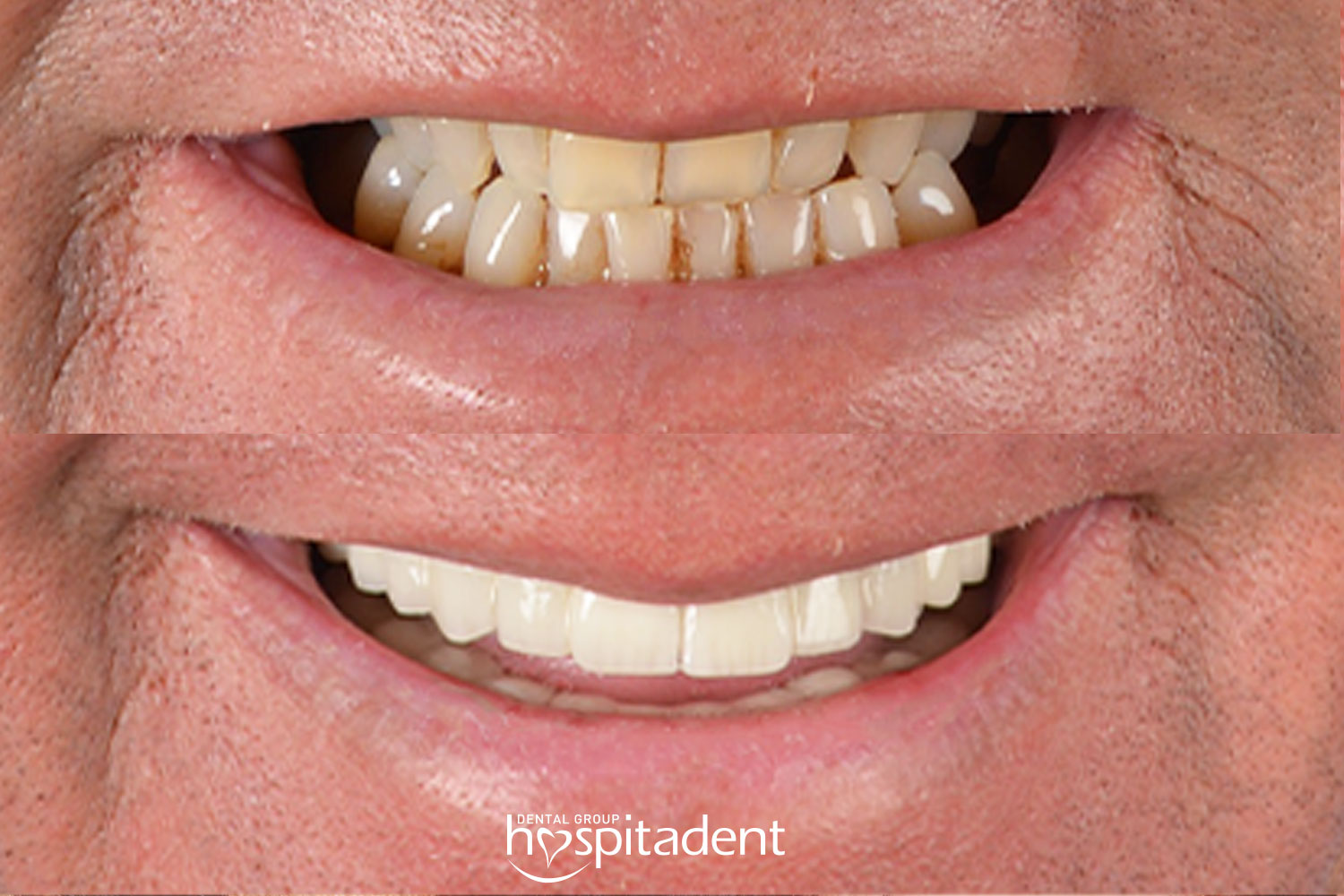 Facettes Dentaires — Hospitadent