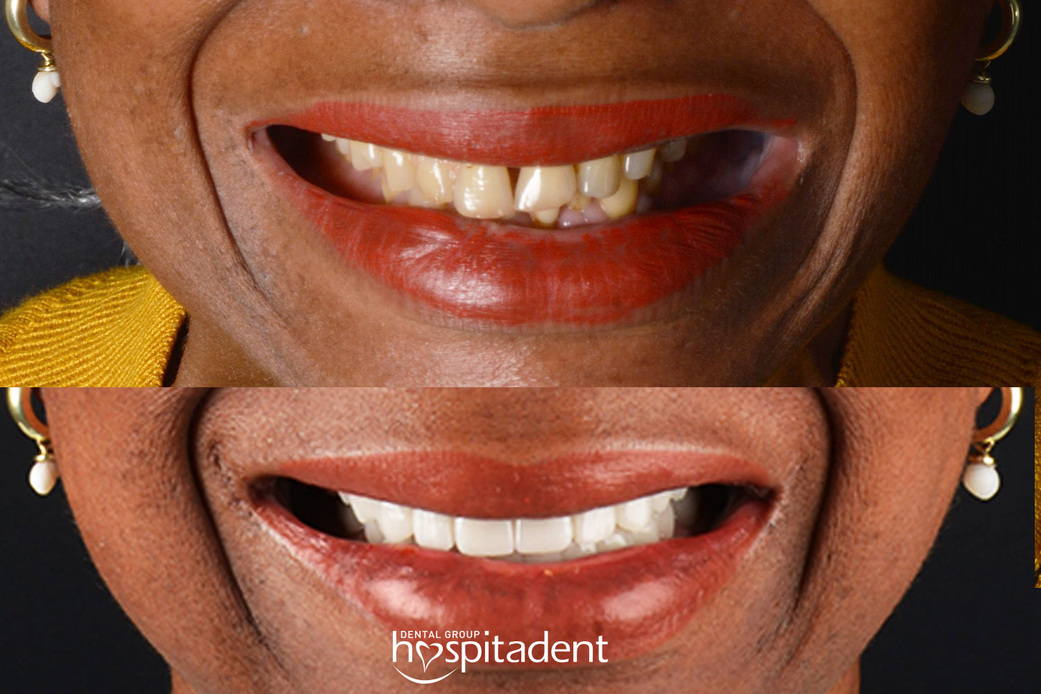 Facettes Dentaires — Hospitadent