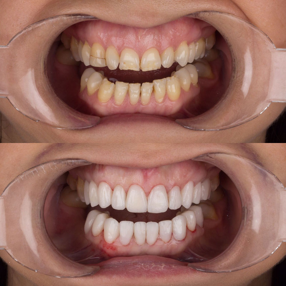 Facettes Dentaires — Dentaglobal