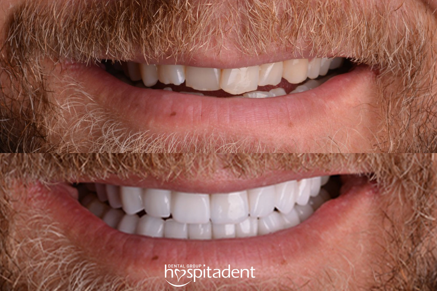 Facettes Dentaires — Hospitadent