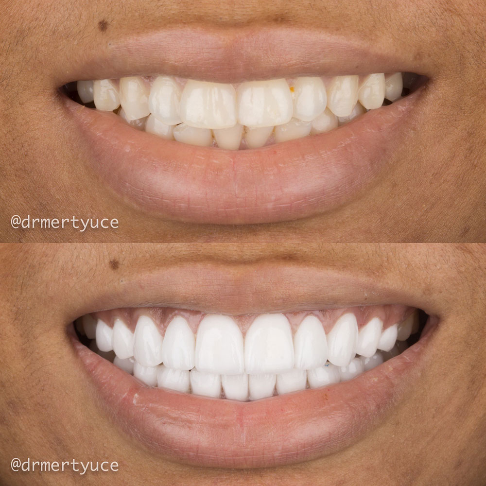 Facettes Dentaires — Dentaglobal