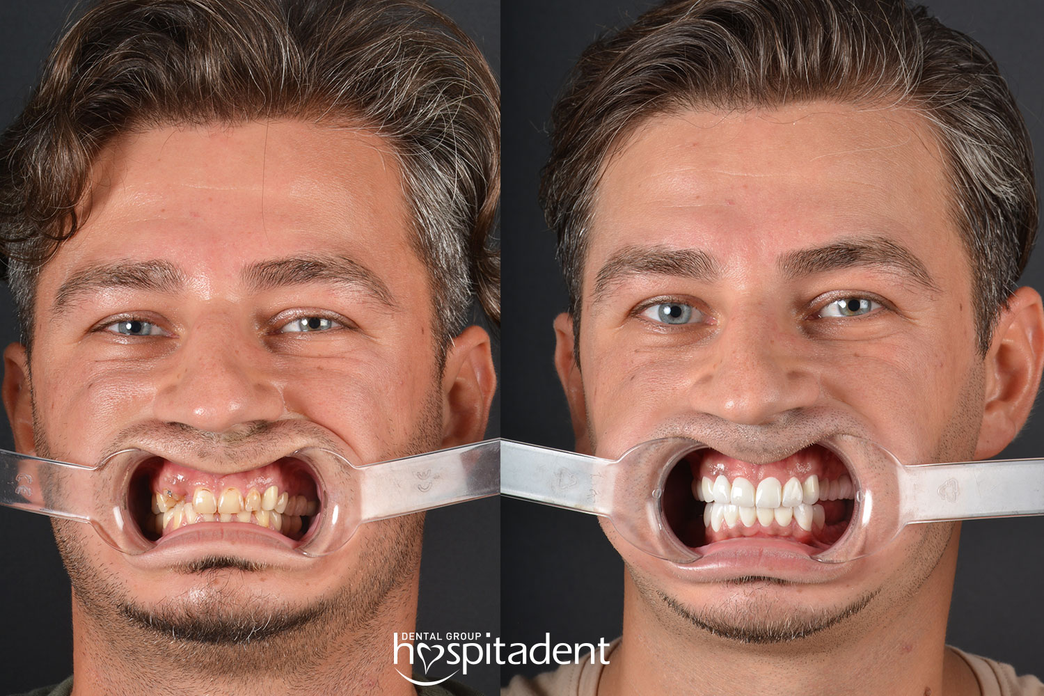 Facettes Dentaires — Hospitadent