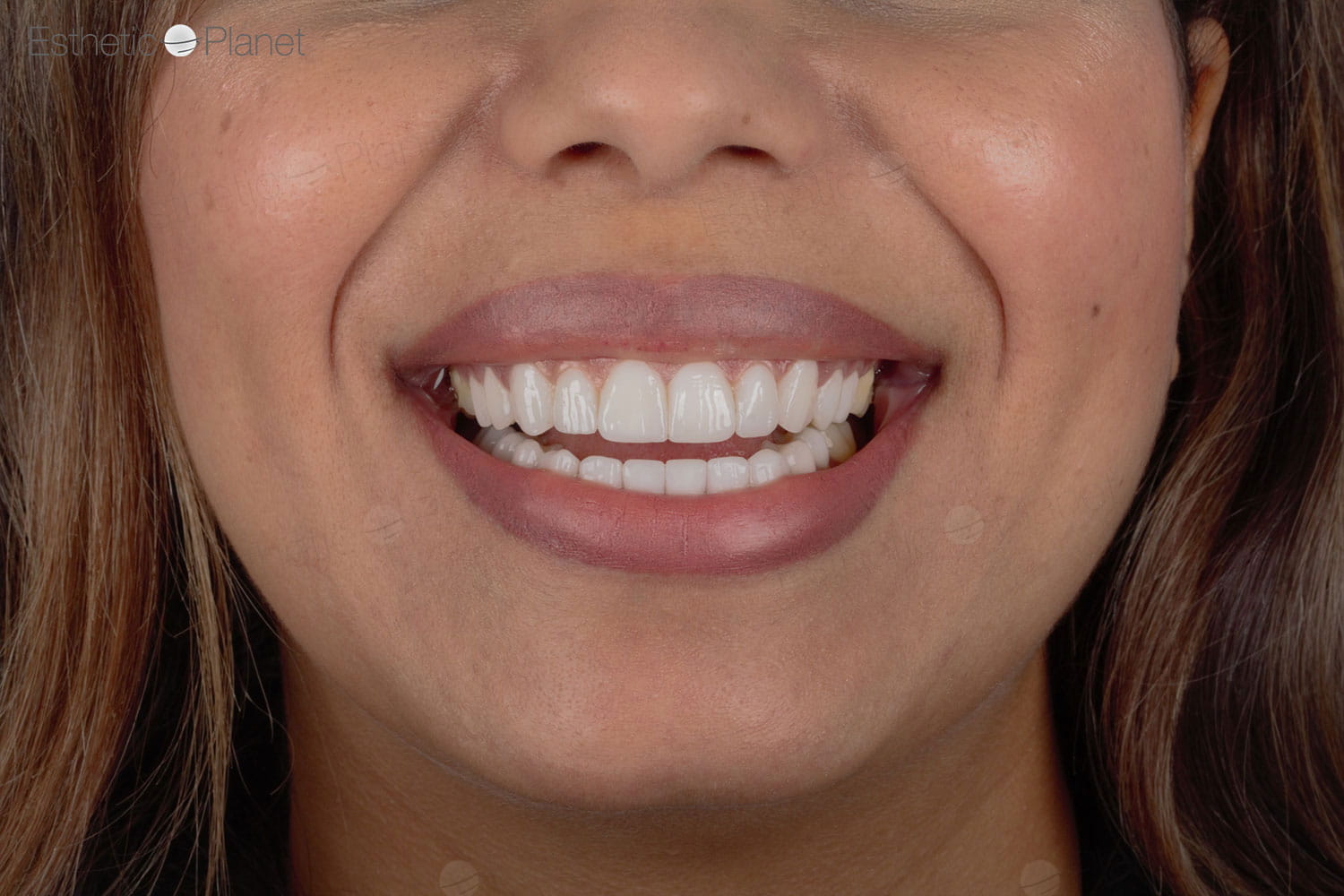 Facettes Dentaires — Dentaglobal