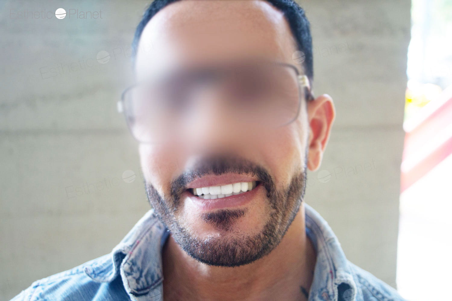 Facettes Dentaires — Dentaglobal