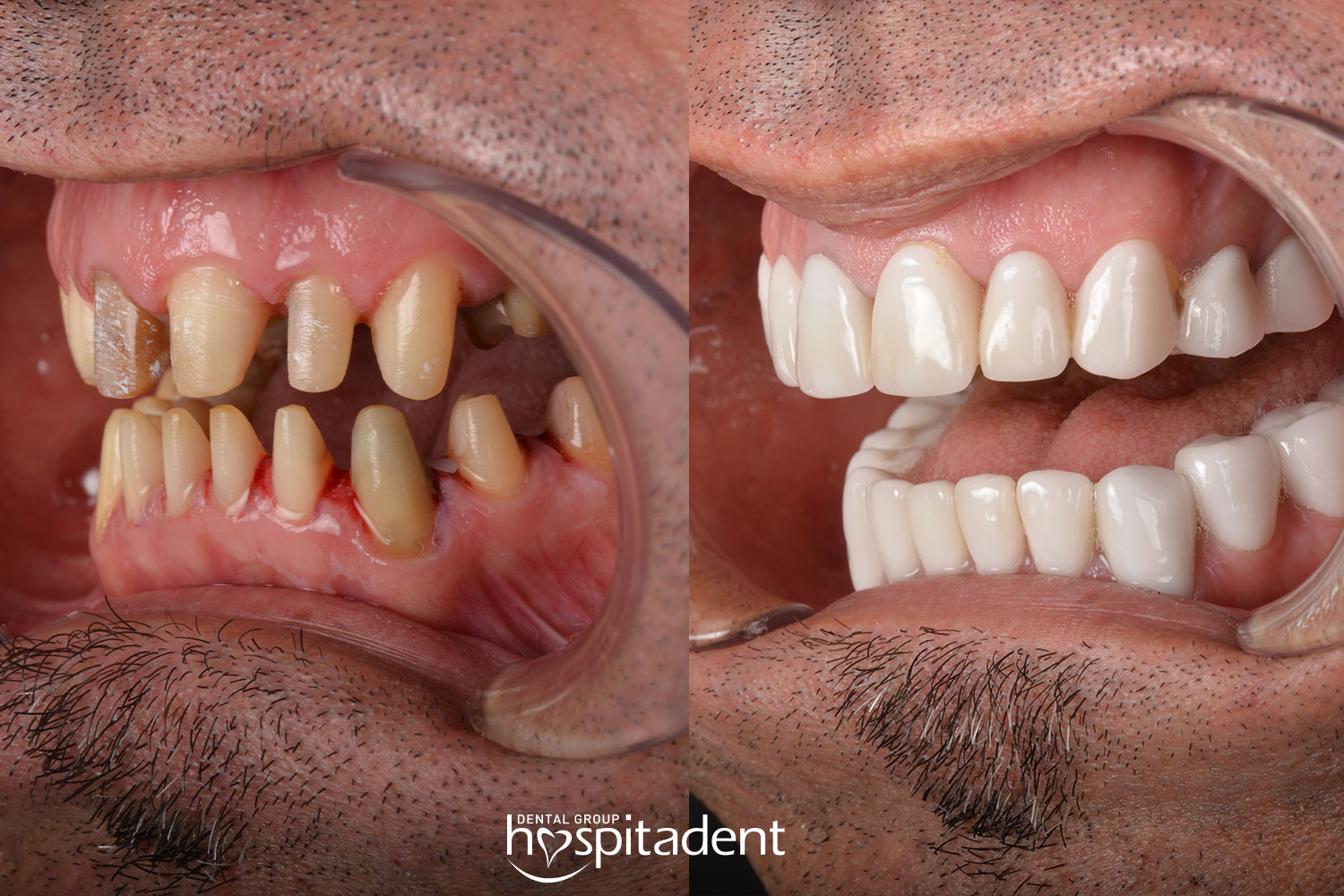 Hollywood Smile — Hospitadent
