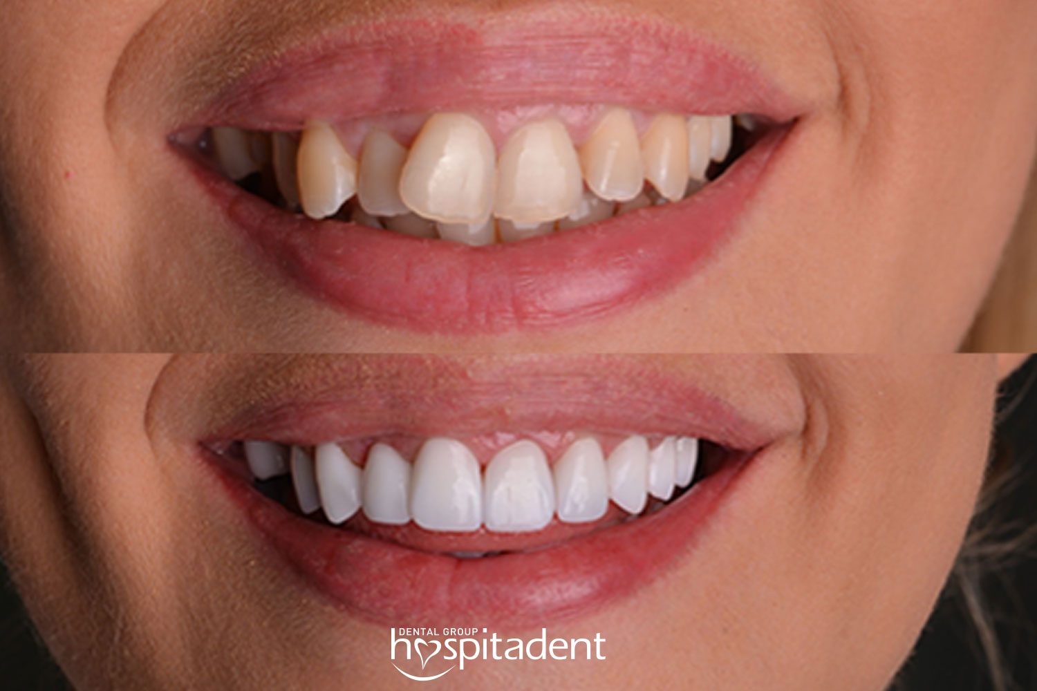 Hollywood Smile — Hospitadent
