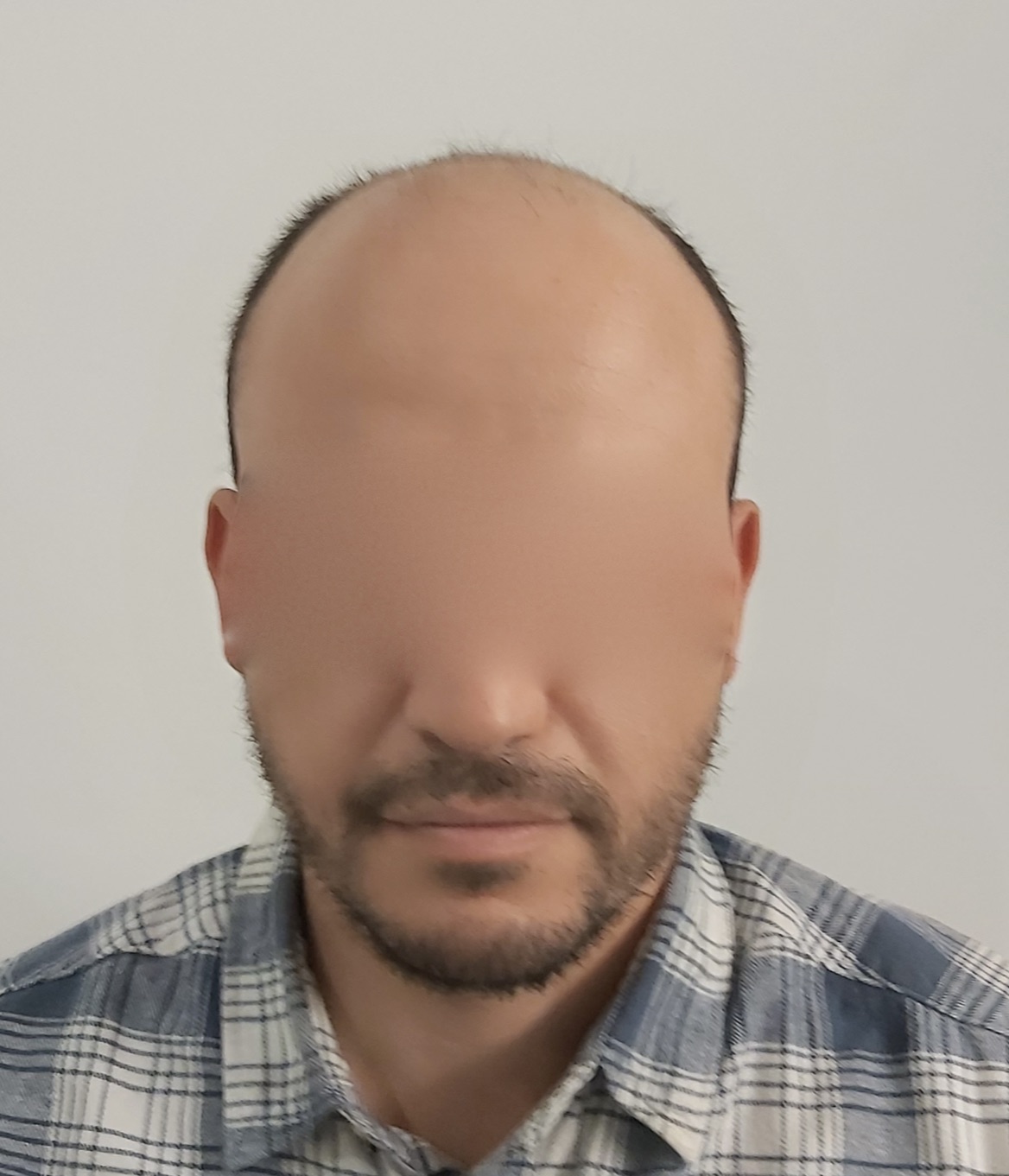 FUE — Dr Sofiene Ouerghi