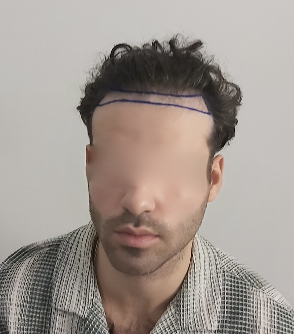 FUE — Dr Sofiene Ouerghi
