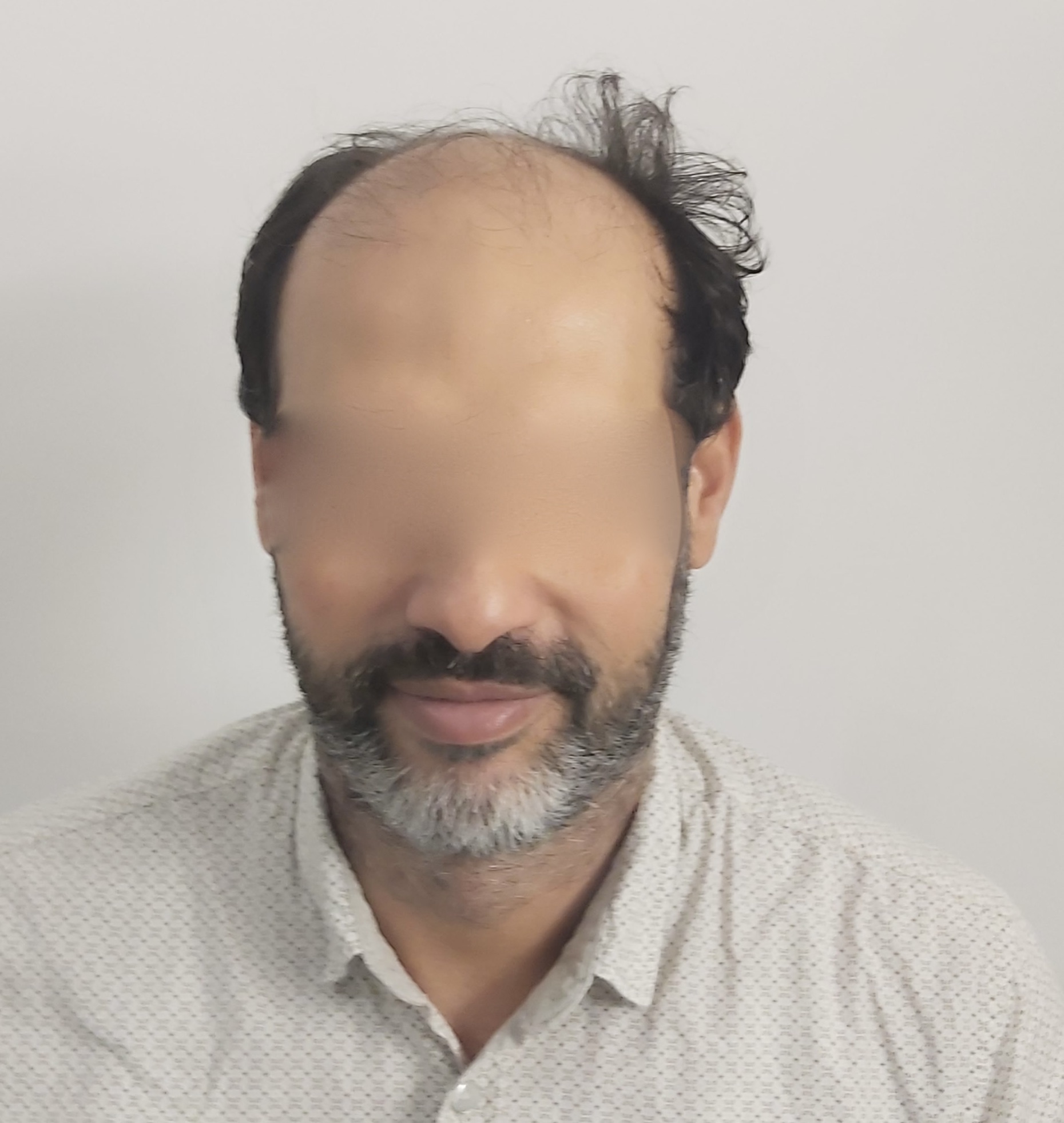 FUE — Dr Sofiene Ouerghi