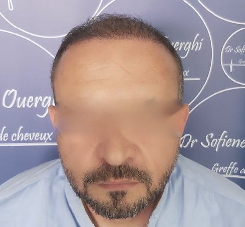 FUE — Dr Sofiene Ouerghi