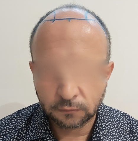 FUE — Dr Sofiene Ouerghi