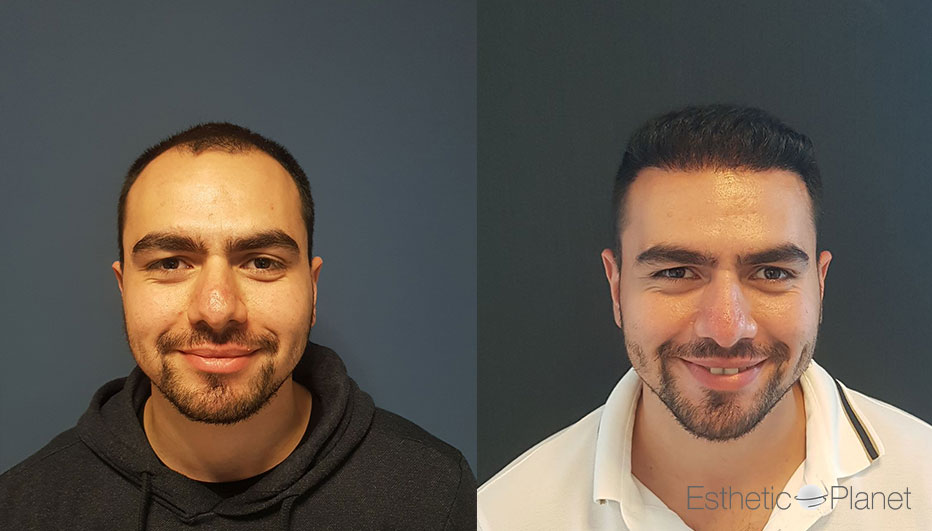 FUE — Dr Ergin Er - FUE & DHI team