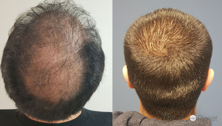 FUE — Dr Ergin Er - FUE & DHI team
