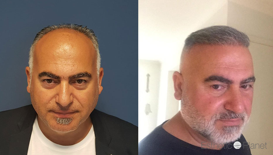 FUE — Dr Ergin Er - FUE & DHI team