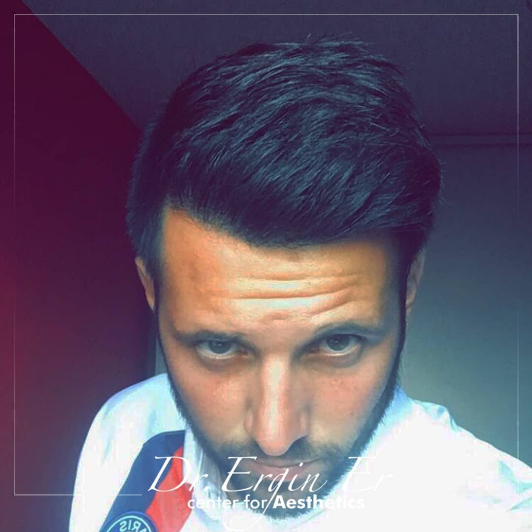 FUE — Dr Ergin Er - FUE & DHI team