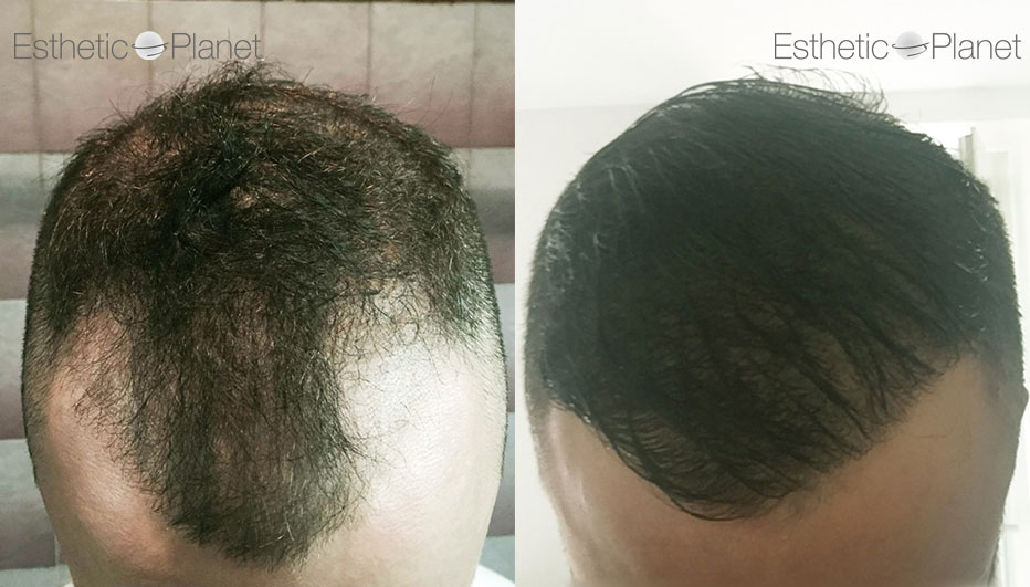 FUE — Dr Ergin Er - FUE & DHI team