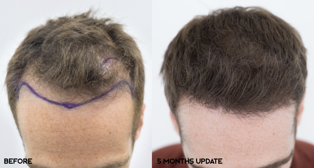 FUE — Dr. Bruno Ferreira